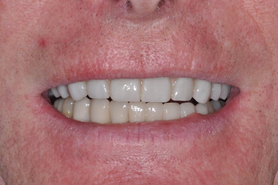 Teeth in a Day Procedure - After - 3Dental Dublin & Limerick